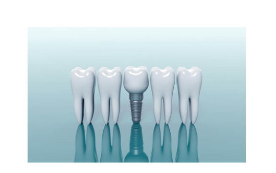 orthodontists recommend dental implants