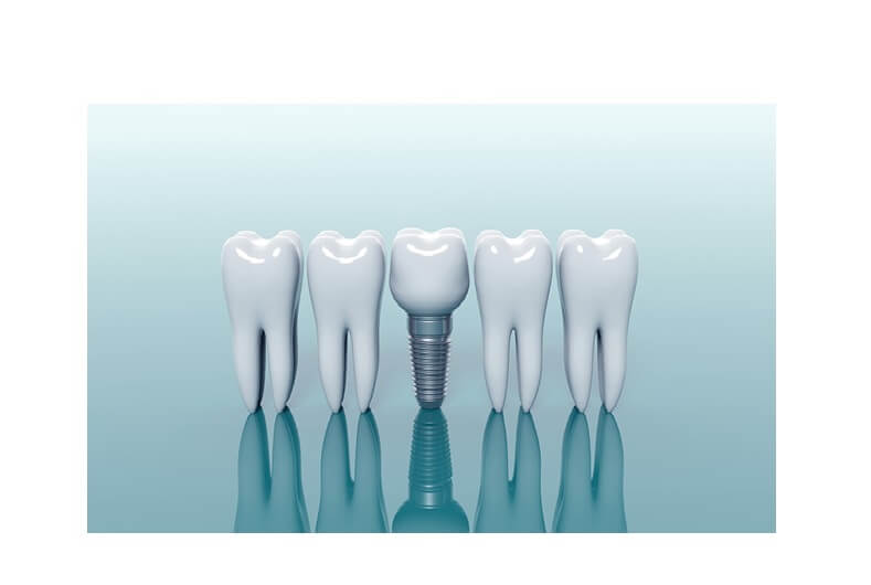 orthodontists recommend dental implants