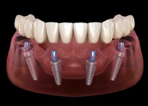 Is Dental Implant Comfortable?