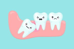 Why Do We Need Wisdom Teeth Removal?