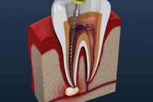 What Is a Tooth Root Infection?